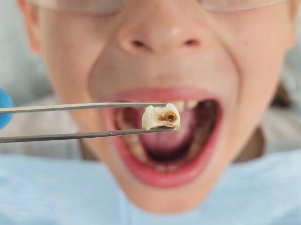 Best Urgent Care for Lost Fillings or Crowns in East Richmond Heights, CA